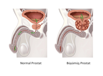 iyi-huylu-prostat