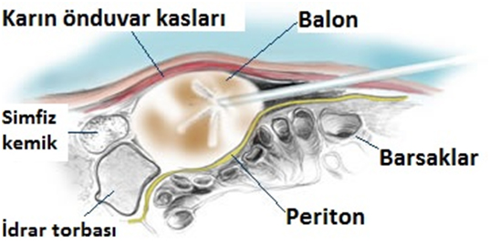 periton zarı
